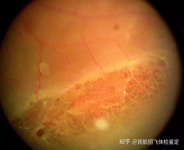 3,视网膜蜗牛迹样改变