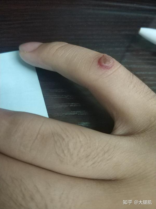 处理手指上皮肤疣的两个办法