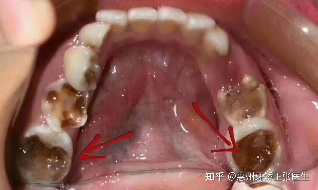孩子乳牙龋坏的救星预成冠