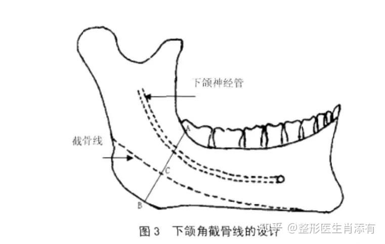 肖添有分享什么是颏侧截骨