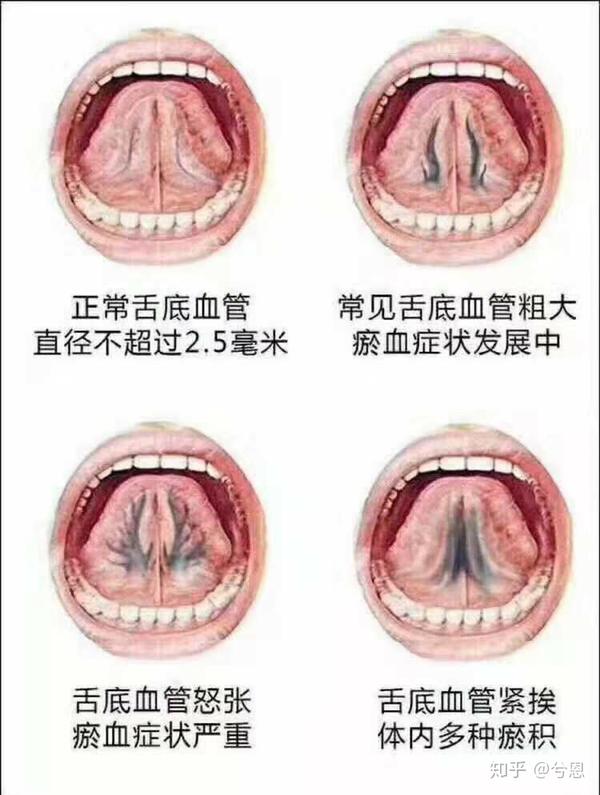 我的灸疗日记之母亲的瘀血希望艾灸走进千家万户带给每个人内心以温暖