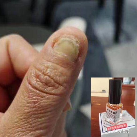 灰指甲的病因是什么?