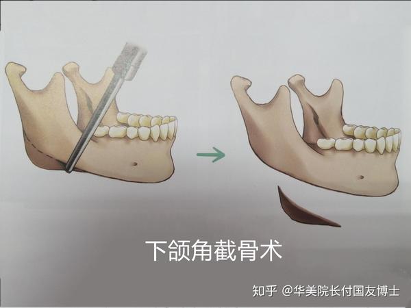 下颌角宽大究竟是怎么回事又该怎么矫正呢