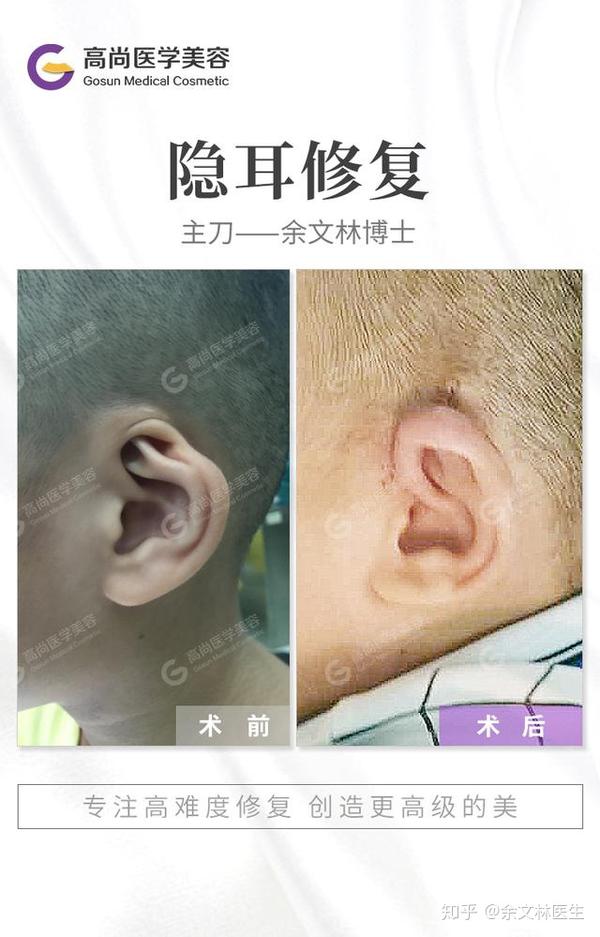 关于小耳畸形,需要做听力重建吗?