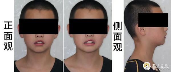 正畸病例替牙期矫治病例1例
