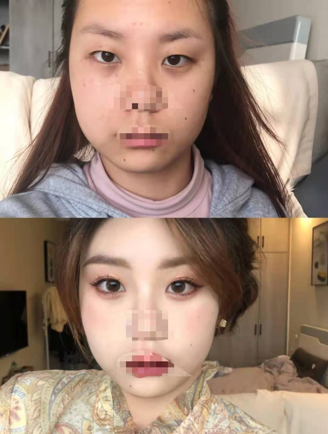 单眼皮做完双眼皮之后变化有多大
