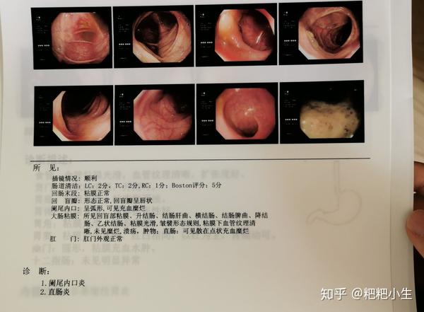 直肠炎(散在点状糜烂)阑尾内口炎(阑尾内口充血糜烂)