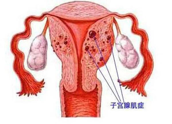 子宫肌腺症什么鬼