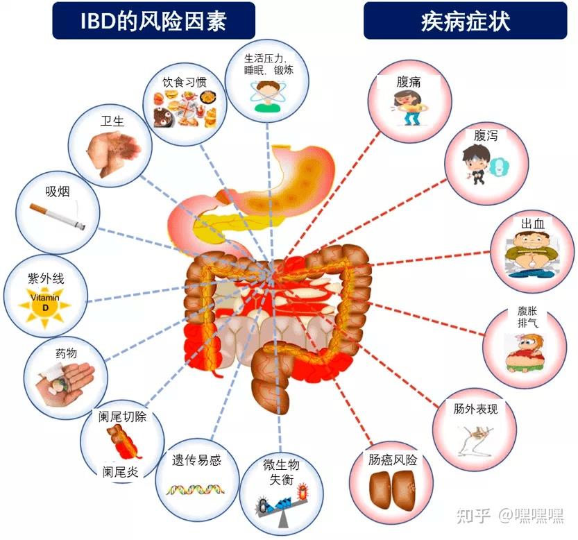 溃疡性结肠炎干细胞以其突出的免疫调节能力在自身免疫性疾病领域的大量研究及临床应用为炎症性肠病提供了新的治疗思路新药免费试用 知乎