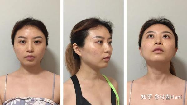 桃乐丝的颧骨有 轻微外扩,位置较高,使面中相对较扁平,使宽面观感更