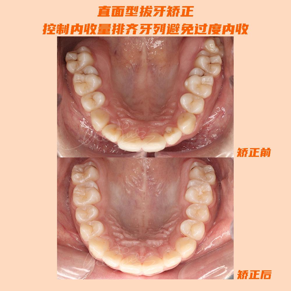 重庆牙齿矫正直面型矫正内收太多小心变瘪嘴