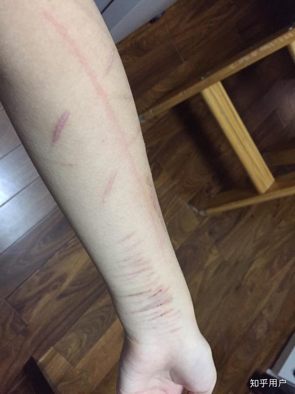 抑郁症焦虑症狂躁症到底有多煎熬?