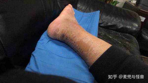 跟腱断裂术后一些感觉,大家一起分享和讨论下