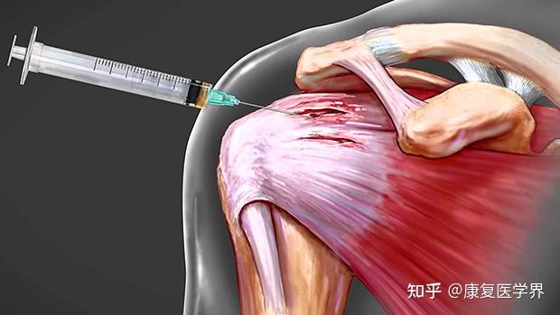 省医专家联合会诊 治愈坐骨结节滑囊炎 知乎