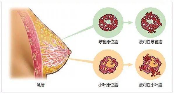 1,乳房表面或周边的皮肤产生皱褶这可能意味着乳房内部有肿块,致使