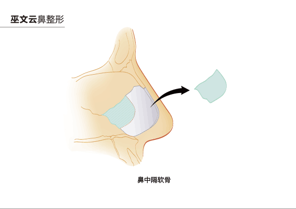 鼻尖整形首选鼻中隔软骨及耳软骨的重要意义