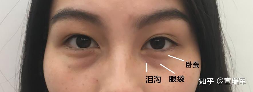 请问下我这个是卧蚕还是眼袋