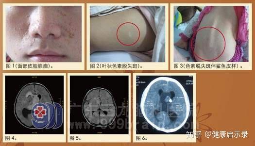结节性硬化症的症状表现