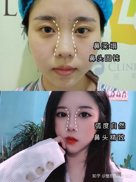 改变是巨大的     术前分析: 正面看鼻子是典型的肉鼻,鼻背宽.