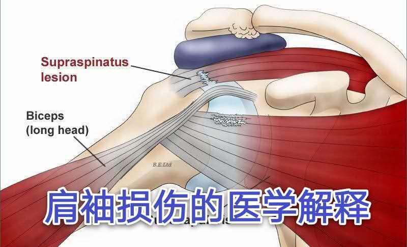 肩袖损伤的医学解释