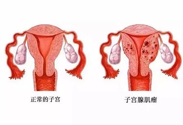 怀孕检查出子宫肌瘤能在生孩子的时候直接拿掉吗
