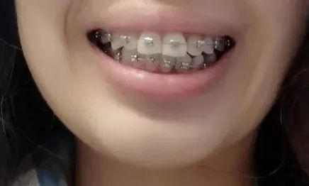 牙齿矫正自锁和非自锁的区别?