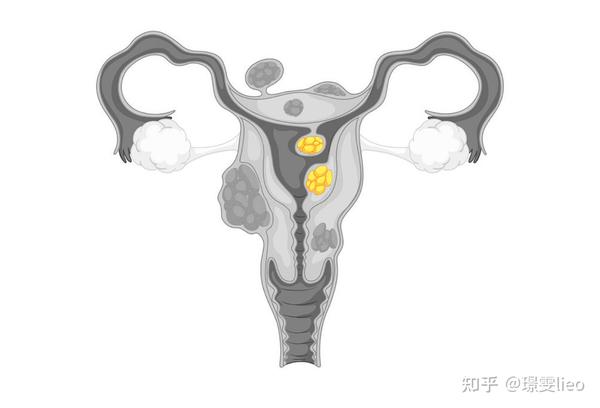 试管备孕遇见子宫肌瘤该如何处理?