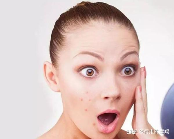 痘痘形成的主要原因有四个:表皮代谢异常,皮脂分泌旺盛,痤疮杆菌感染