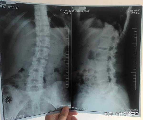 这是我的腰椎x光,很明显的看到侧弯曲