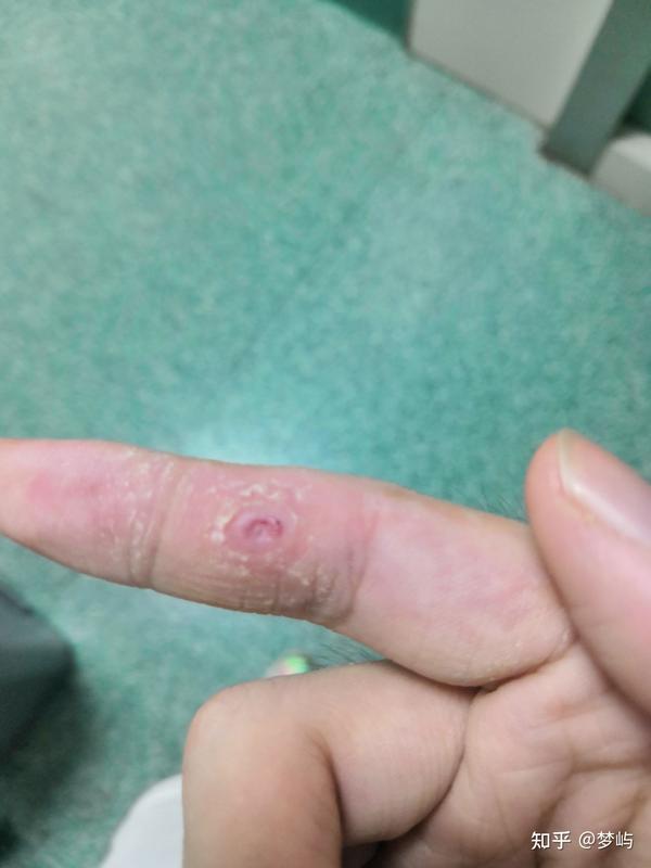 液氮冷冻治疗寻常疣记录帖ー