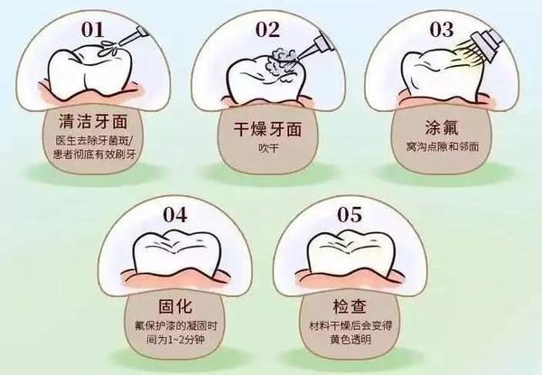 窝沟封闭能大大降低患蛀牙的概率,是世界卫生组织(who)推荐的预防龋齿