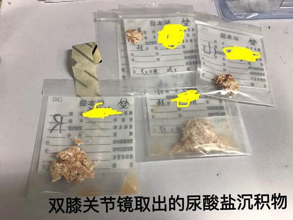 【痛风】恶魔的珠宝:痛风石(4)——覆灭
