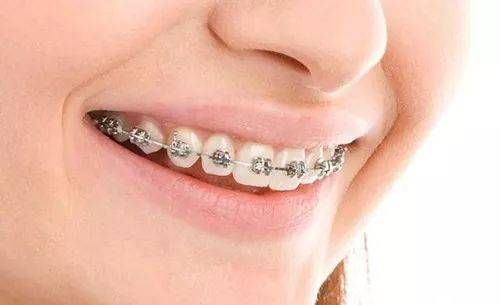 福州牙齿矫正正畸金属陶瓷隐形舌侧哪种牙套比较好费用各是多少怎么选
