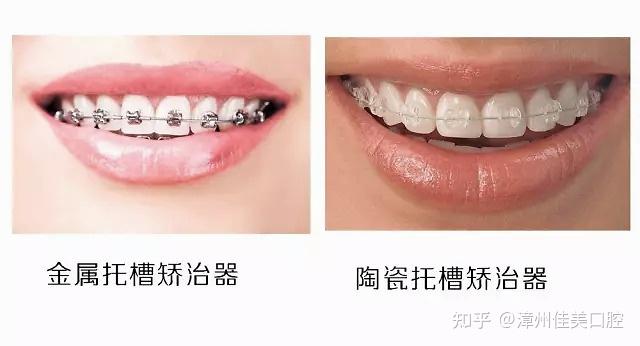 漳州寒假牙齿矫正活动:牙齿矫正的黄金时期!