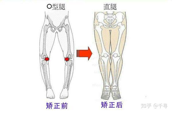 xo型腿,绑腿有用吗?