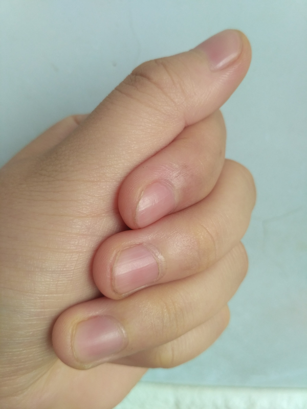 困扰了很多年的甲周疣,在右手的中指上,疣体已经占据了指甲的一半.