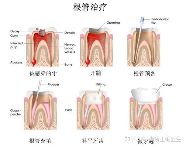 杀过神经的牙齿掉了一块可以不管吗