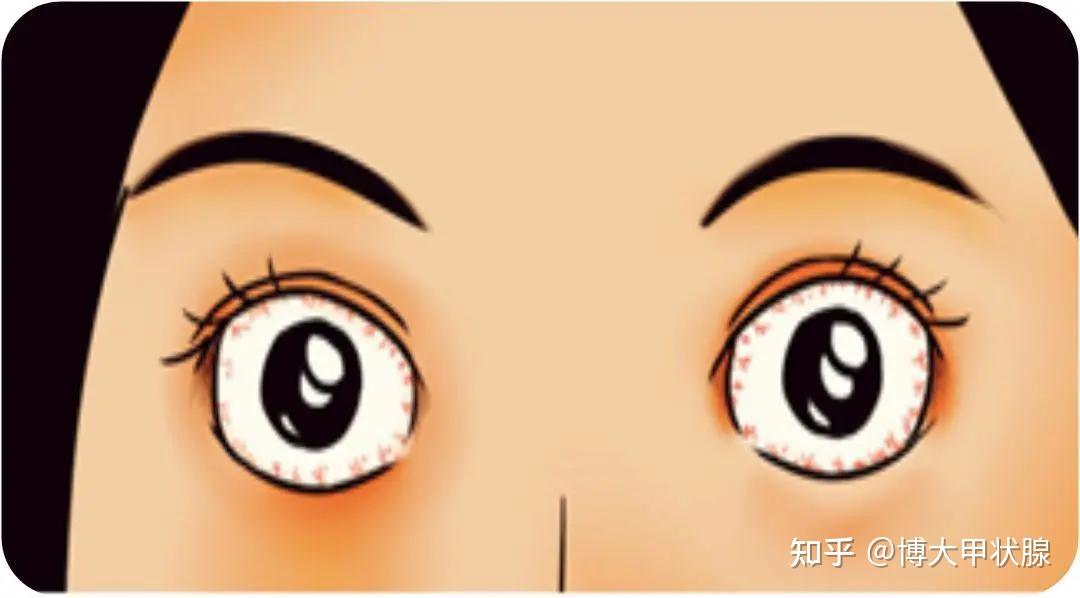 4甲状腺相关眼病出现眼睑退缩和迟落,眼球暴露面积增加,泪液蒸发加速