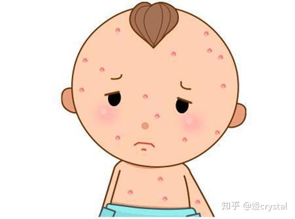 一,为什么宝宝打过疫苗还会出水痘?
