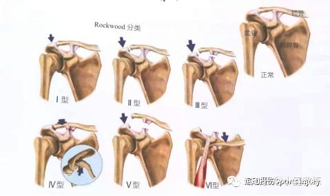 21种肩关节症状肩锁关节损伤