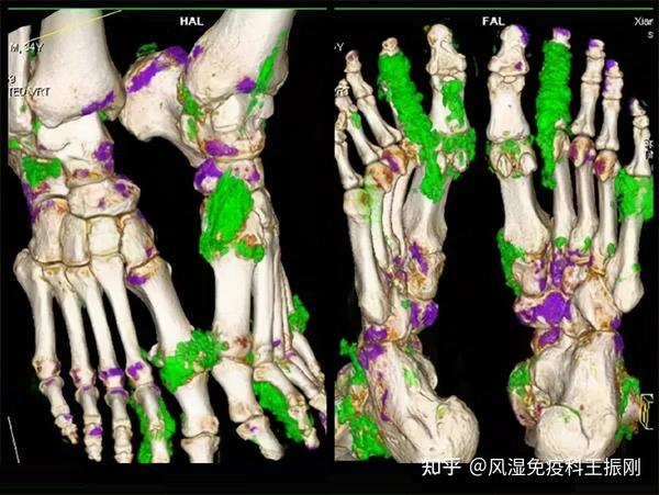 男子痛风后病急乱投医被误诊为腱鞘炎,不规范治疗双手长出痛风石