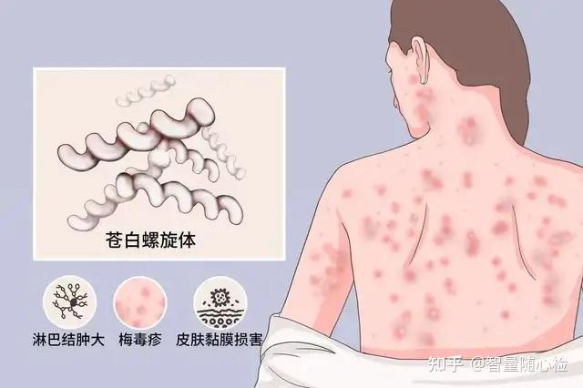 梅毒是怎么来的 zhuanlan.zhihu.com