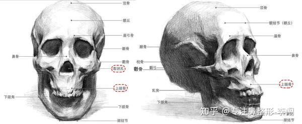 这时基本可确认为鼻基底凹陷,由于上颌骨发育不足,梨状孔凹陷,与嘴唇