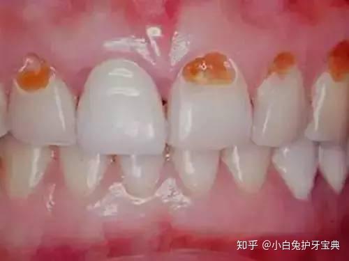 19岁美女一口牙齿被"溶解",只是因为喝可乐?
