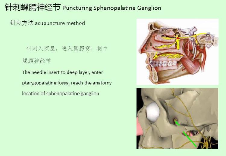 首大杨威:针刺蝶腭神经节治疗过敏性鼻炎