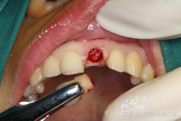 门牙外伤折断即拔即种即刻修复一例