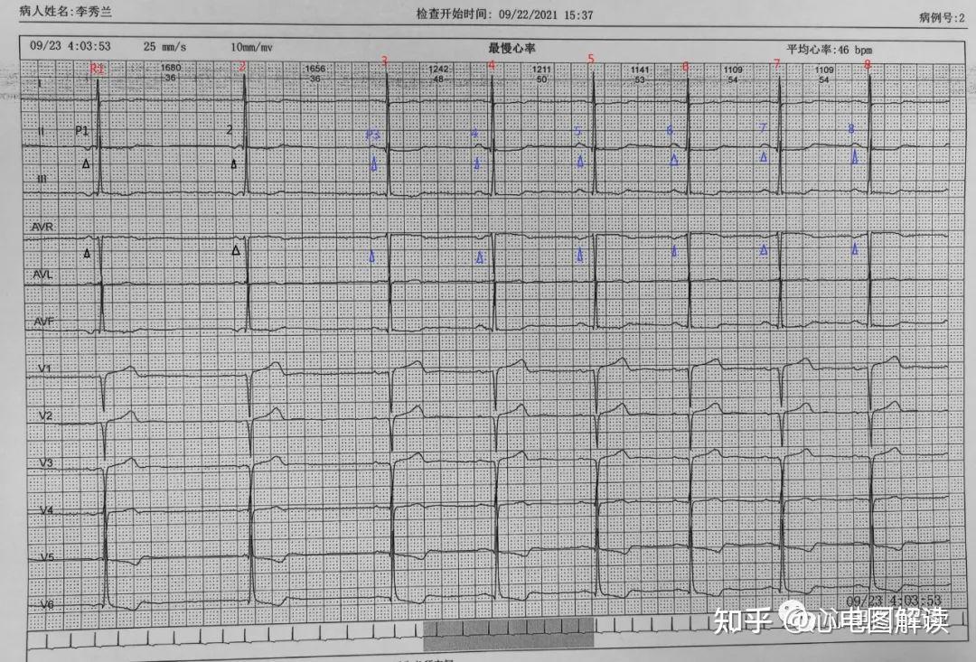 今天要分享的心电图