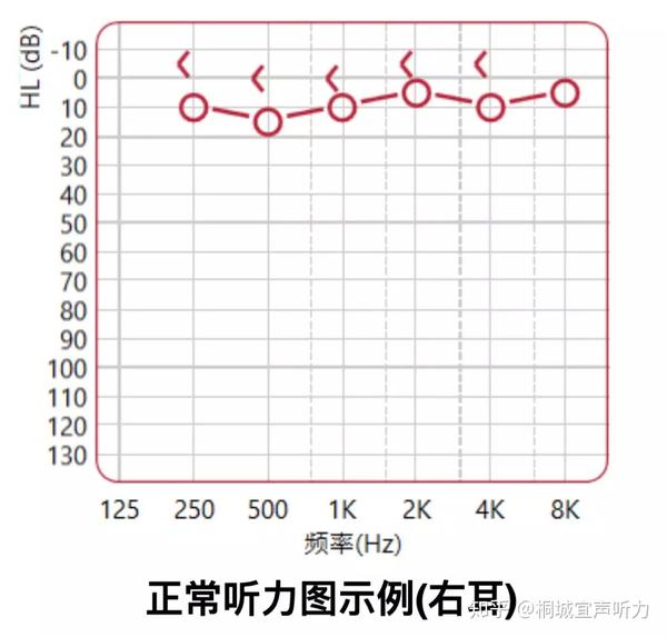 首先,我们来了解一下正常听力,在听力图上,其气骨导阈值都应当在正常