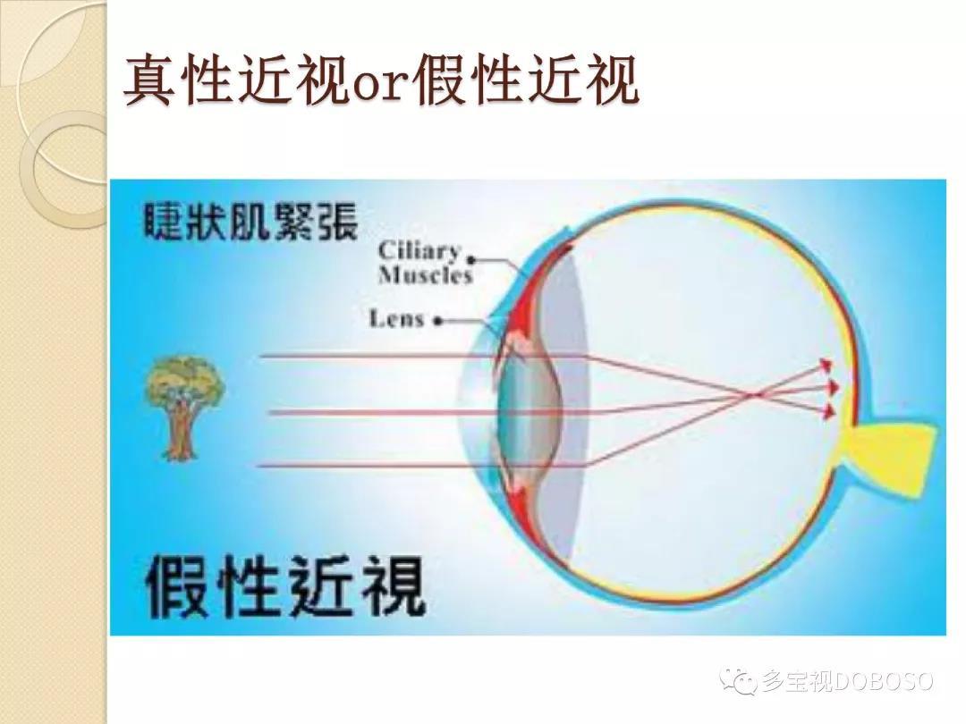 中山眼科斜弱视大讲堂邱璇博士近视和弱视