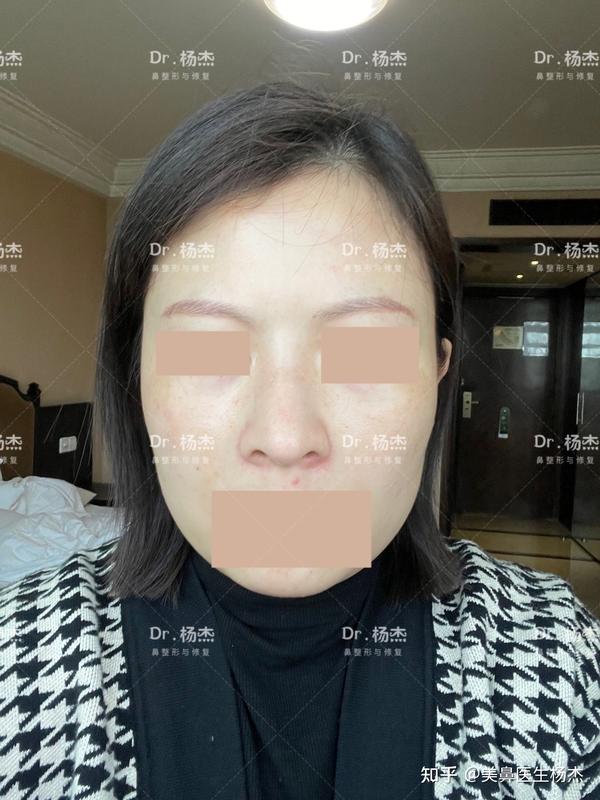 【案例3】 鼻翼疤痕修复一个半月反馈